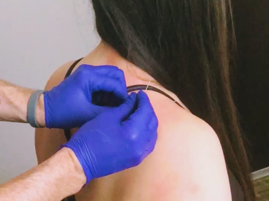Dry needling on a patient’s upper back